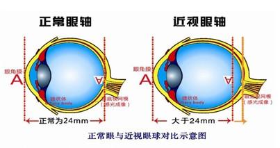 在昆明怎么纠正近视眼